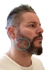 Bart übergang mit glatze 5 GrÃ¼nde